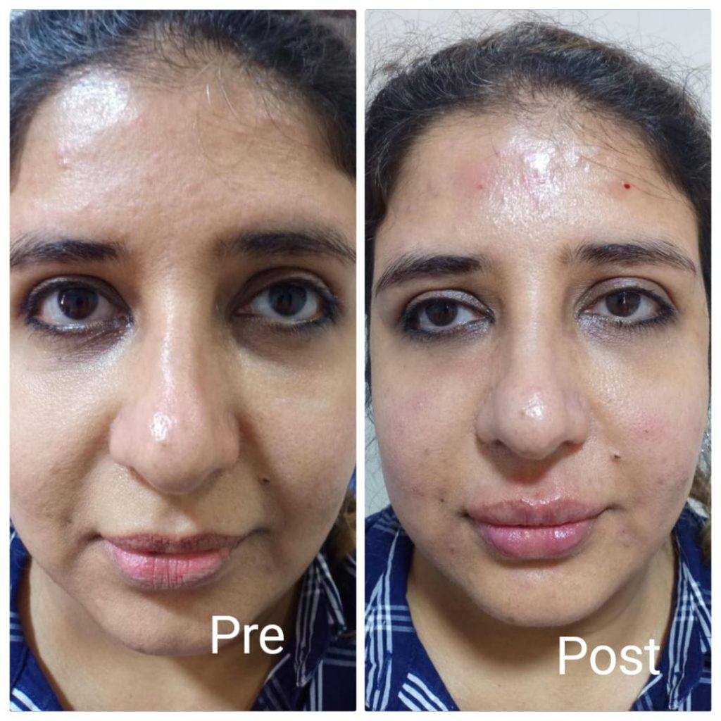 فيلر الخدود قبل وبعد